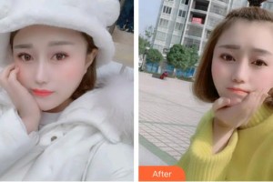 臺(tái)州市博愛醫(yī)院整形美容科王肖琴整形價(jià)格表附金屬托槽矯正案例展示