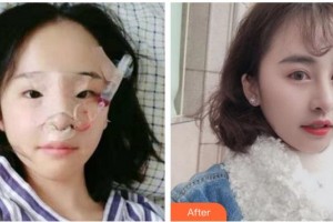 臺州華美整形美容醫(yī)院劉政整形價格表附鼻部綜合案例展示