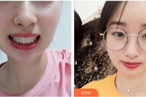 臺州維多利亞整形美容醫(yī)院于文學整形價格表附牙齒隱形矯正案例展示