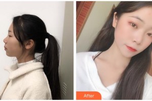 臺州維多利亞整形美容醫(yī)院蔡意整形價格表附光子嫩膚案例展示