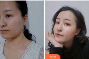 臺州維多利亞整形美容醫(yī)院劉燕玉整形價格表附埋線提升案例展示