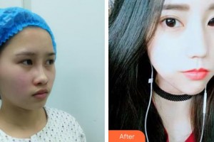 臺州維多利亞整形美容醫(yī)院陸新整形價格表附埋線提升案例展示