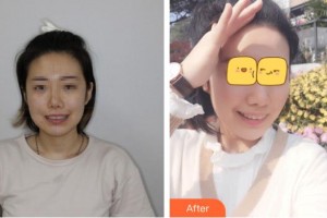 臺州維多利亞整形美容醫(yī)院藍海慧整形價格表附牙齒隱形矯正案例展示