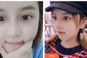 臺州維多利亞整形美容醫(yī)院上敏明整形價格表附假體隆鼻案例展示