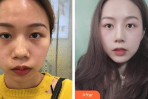 臺州臨海市蔣氏美容整形外科診所蔣未臺整形價格表附鼻部綜合案例展示