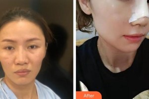 臺州醫(yī)院燒傷整形科鄭金滿整形價格表附鼻部修復案例展示