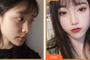 臺州骨傷醫(yī)院整形美容科蔣冰峰整形價格表附埋線提升案例展示