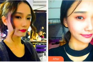 臺州歐亞整形醫(yī)院占鈺整形價格表附熱瑪吉案例展示