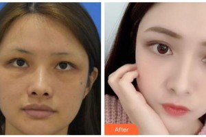 臺州愛美美萊醫(yī)療美容門診部金潔整形價格表附埋線提升案例展示