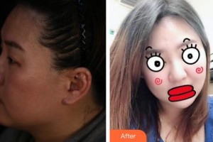 臺州愛美美萊醫(yī)療美容門診部劉冠超整形價格表附埋線提升案例展示