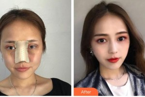 臺州愛美美萊醫(yī)療美容門診部王俊整形價格表附鼻部綜合案例展示