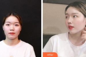 臺州維多利亞整形美容醫(yī)院金炳湘整形價格表附肋軟骨隆鼻案例展示