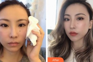 臺州維多利亞整形美容醫(yī)院尹建蘭整形價格表附埋線提升案例展示