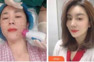 臺州博雅美惠醫(yī)療美容整形醫(yī)院朱剛強整形價格表附熱瑪吉案例展示