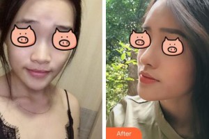 臺州納恩妮亞醫(yī)療美容醫(yī)院崔妮娜整形價格表附鼻部綜合案例展示