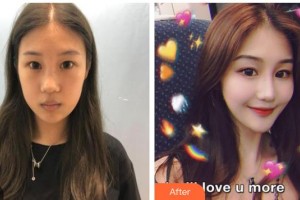 臺州蘭天醫(yī)療美容診所張殷整形價格表附眼部綜合案例展示