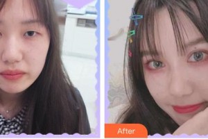 臺州恩璨醫(yī)療美容門診部鐘銀祥整形價格表附眼部綜合案例展示