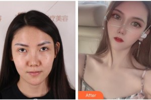 臺州韓爾口腔門診部郟海江整形價格表附切開雙眼皮案例展示