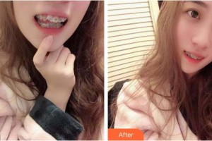 臺州韓爾口腔門診部陳學(xué)良整形價格表附金屬托槽矯正案例展示