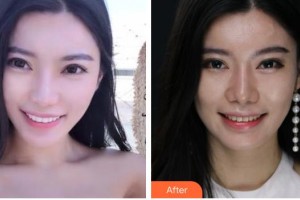 臺州牙科醫(yī)院梁利榮整形價格表附美白貼片案例展示