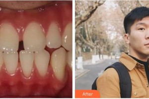 臺州牙科醫(yī)院林松整形價格表附金屬托槽矯正案例展示