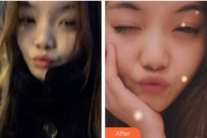 臺州牙科醫(yī)院王佰軍整形價格表附牙齒隱形矯正案例展示