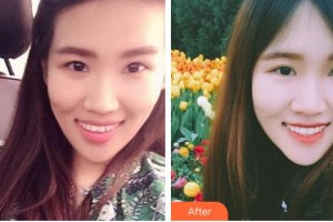 臺州牙科醫(yī)院金文軍整形價格表附牙齒隱形矯正案例展示