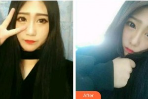 臺州牙科醫(yī)院邱偉強整形價格表附牙齒隱形矯正案例展示