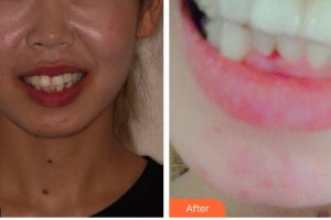 臺州牙科醫(yī)院黃凌凌整形價格表附牙齒隱形矯正案例展示