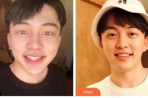 臺州牙科醫(yī)院陳慧整形價格表附美白貼片案例展示