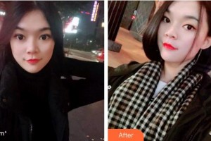 臺州拜博口腔醫(yī)院丁大偉整形價格表附牙齒隱形矯正案例展示