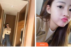 臺州牙科醫(yī)院朱棱鵬整形價格表附牙齒隱形矯正案例展示