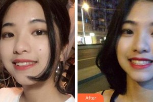 臺(tái)州康貝佳口腔醫(yī)院蔡騎兵整形價(jià)格表附牙齒隱形矯正案例展示