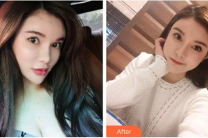 臺(tái)州貝雅口腔醫(yī)院史佩強(qiáng)整形價(jià)格表附超聲波潔牙案例展示