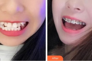 臺(tái)州牙博士口腔門診部簡小沖整形價(jià)格表附金屬托槽矯正案例展示