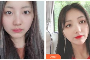 臺(tái)州愛爾眼科醫(yī)院解林根整形價(jià)格表附眼部綜合案例展示