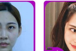 臺(tái)州愛爾眼科醫(yī)院張曉整形價(jià)格表附眼部綜合案例展示