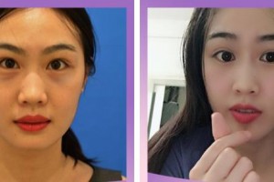 臺(tái)州市第一人民醫(yī)院醫(yī)療美容科程茜整形價(jià)格表附激光去眼袋案例展示