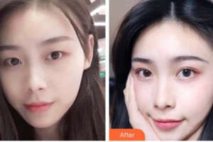 臺(tái)州國際眼科醫(yī)院王一博整形價(jià)格表附切開雙眼皮案例展示