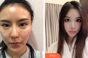 臺(tái)州國際眼科醫(yī)院崔樂樂整形價(jià)格表附下瞼整形案例展示