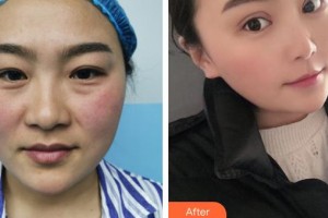 臺(tái)州國際眼科醫(yī)院丁陽整形價(jià)格表附外切祛眼袋案例展示