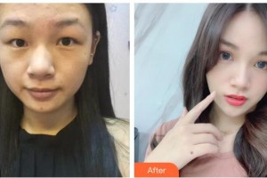 臺(tái)州國際眼科醫(yī)院鄭丹整形價(jià)格表附激光去眼袋案例展示