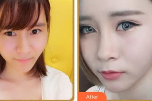 臺(tái)州國際眼科醫(yī)院張美君整形價(jià)格表附眼部綜合案例展示