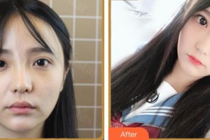 臺州國際眼科醫(yī)院白建海整形價格表附眼部綜合案例展示