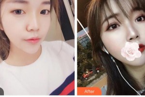 臺州國際眼科醫(yī)院趙澤林整形價格表附切開雙眼皮案例展示