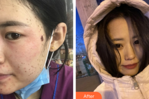 深圳美芮（原雅唯）醫(yī)療美容門診部呂方中整形價(jià)格表附超激光美膚祛斑案例展示