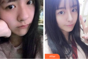 深圳美芮（原雅唯）醫(yī)療美容門診部符國(guó)興整形價(jià)格表附熱瑪吉多方面部案例展示