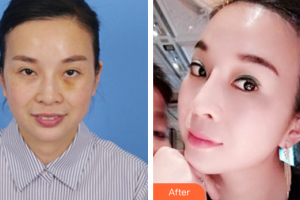 深圳美芮（原雅唯）醫(yī)療美容門診部唐建軍整形價(jià)格表附埋線提升案例展示