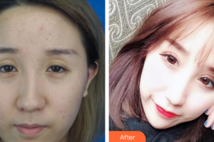 深圳美芮（原雅唯）醫(yī)療美容門診部羅凱整形價(jià)格表附切開雙眼皮案例展示