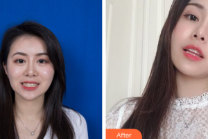 深圳美芮（原雅唯）醫(yī)療美容門診部羅衛(wèi)釵整形價(jià)格表附隱形牙齒矯正案例展示